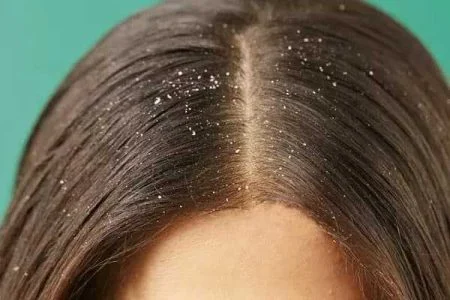 شامپو برای پوست خشک سر