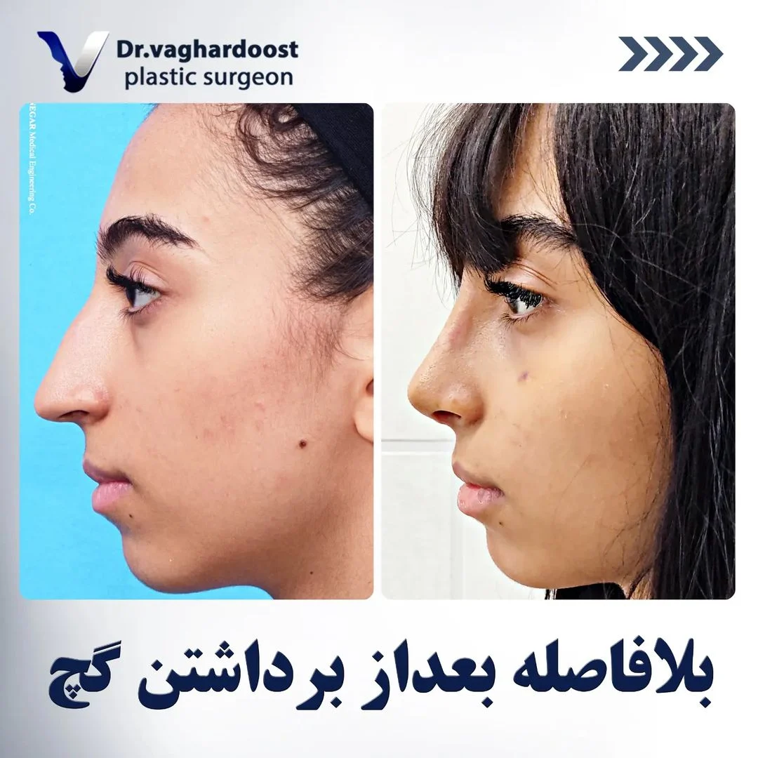 خطرات عمل بینی استخوانی