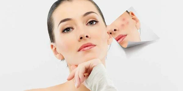  درمان آکنه با طب سنتی؛ راه حل طبیعی و موثر