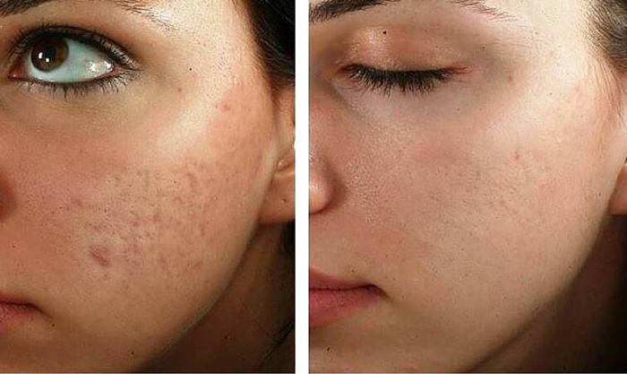 کرم ترمیم کننده صورت برای پوست های آسیب دیده از مواد شیمیایی